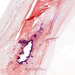 Atheromatosis arteriae (oil-red-o)