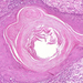 carcinoma planocellulare cutis magdfstés