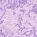adenocarcinoma pulmonis3