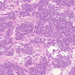 carcinoma ductale invasivum mammae0