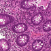 colitis ulcerosa plazmasejtek