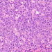 diffúz nagy B-sejtes lymphoma (HE) nagy sejtek