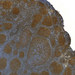 follicularis lymphoma (BCL-2)0