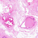 mastopathia fibrocystica apokrin metaplasia