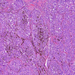 Melanoma malignum cutis1